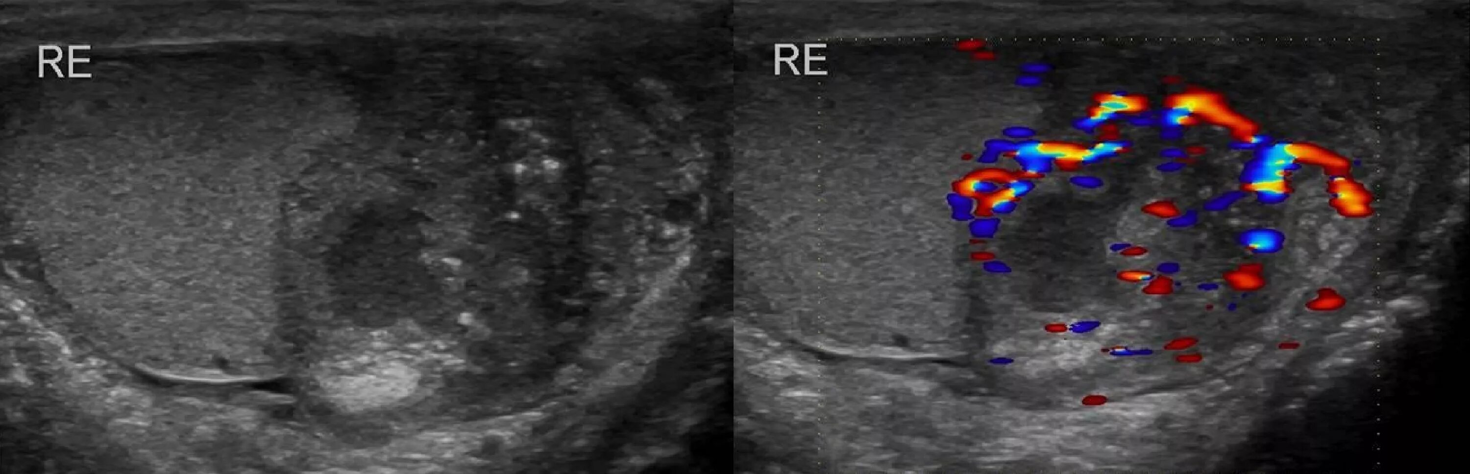 Яйца снизу. Перекрут придатка яичка УЗИ. Перекрут яичка УЗИ картина.