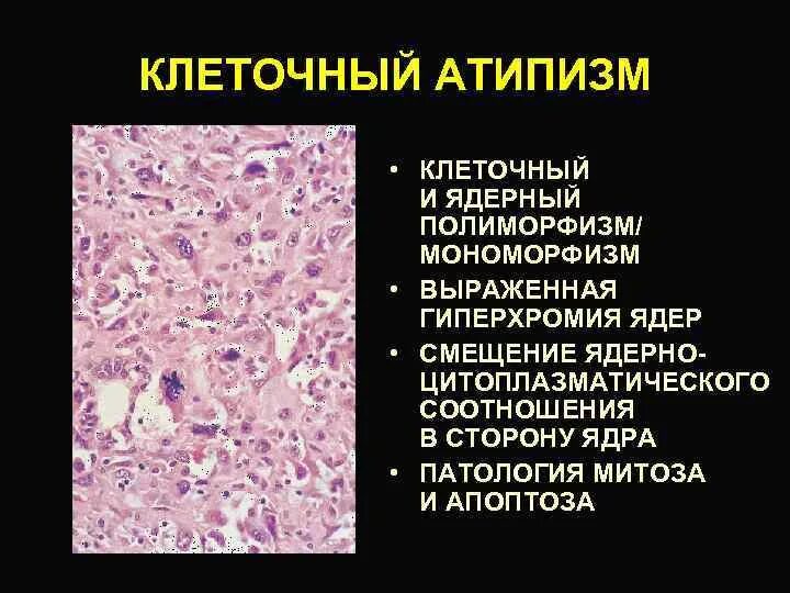 Тканевой и клеточный атипизм опухолей. Проявления клеточного атипизма опухоли. Признаки клеточного и тканевого атипизма. Атипизм опухоли патанатомия. Клетки с гиперхромными ядрами