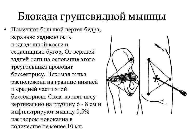 Блокада техника выполнения. Блокада грушевидной мышцы техника. Синдром грушевидной мышцы блокада техника. Схема блокады седалищного нерва. Техника проведения блокады грушевидной мышцы.