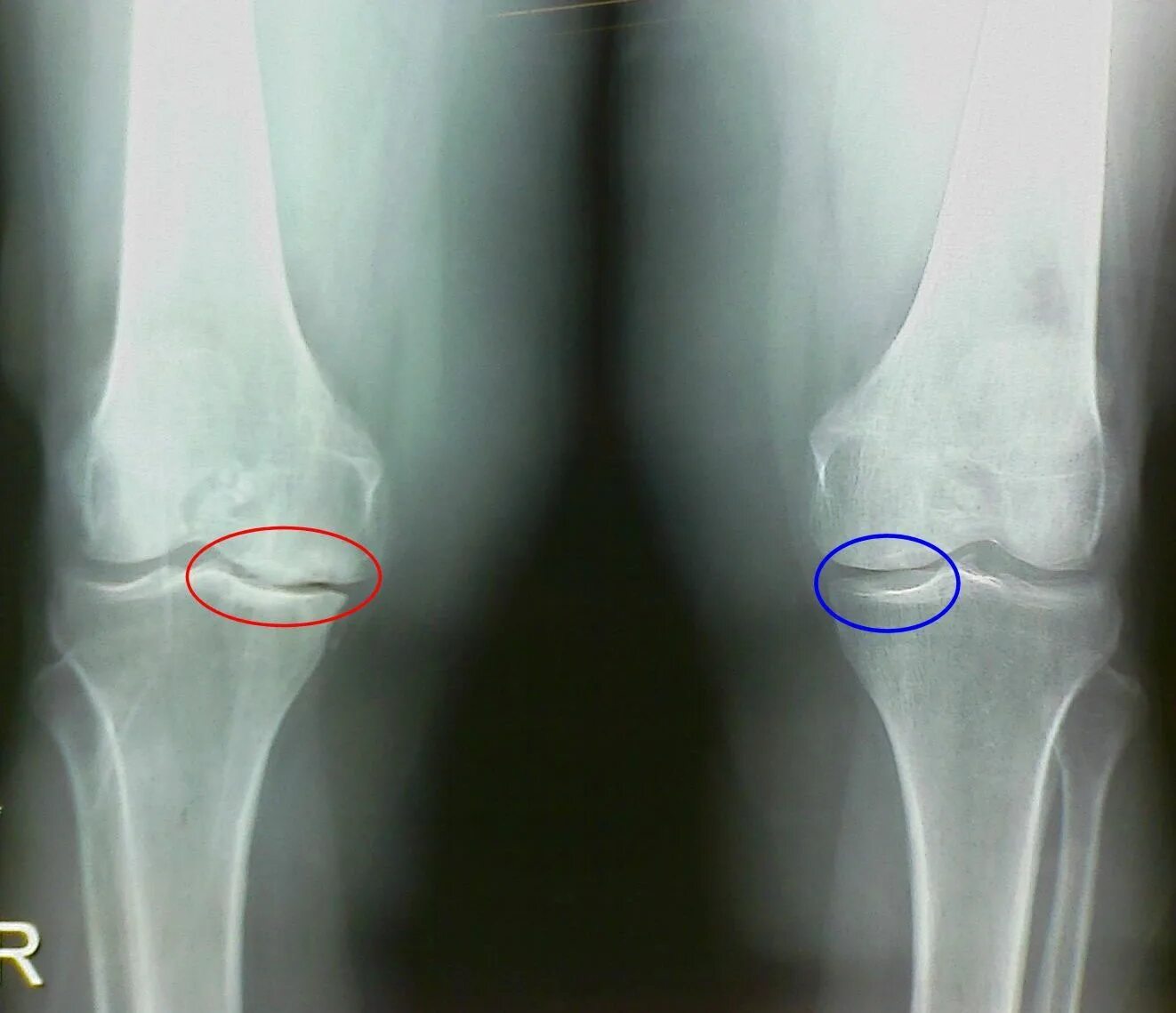 Рентген колена. Рентген колена гонартроз. Остеопороз коленного сустава рентген. Деформирующий остеоартроз рентген.