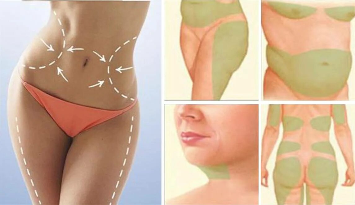 Апельсиновая корка целлюлит. Целлюлит на бедрах и ягодицах как избавиться. Без целлюлита. Апельсиновая корка на бедрах и ягодицах. Избавляем от целлюлита.