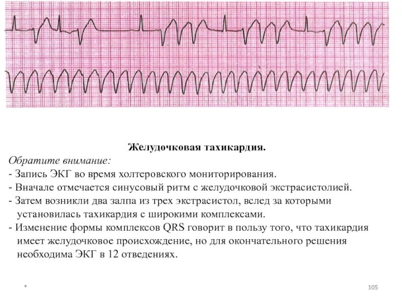 Желудочковая тахикардия на экг. ЭКГ при желудочковой тахикардии. Полиморфная желудочковая тахикардия ЭКГ. ЭКГ желудочковая тахикардия ЭКГ.