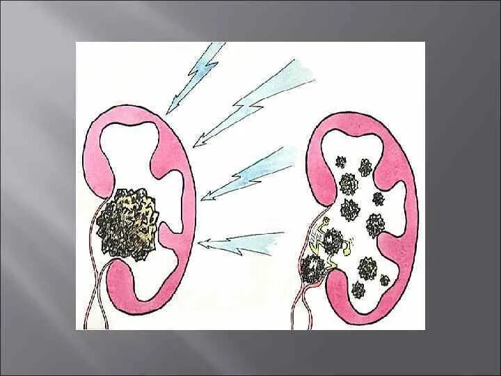 Мочекаменные колики. Почечно-каменная болезнь почечная колика. Мкб почки. Почечная колика. Механизм формирования почечной колики. Мочекаменная болезнь почечная колика.