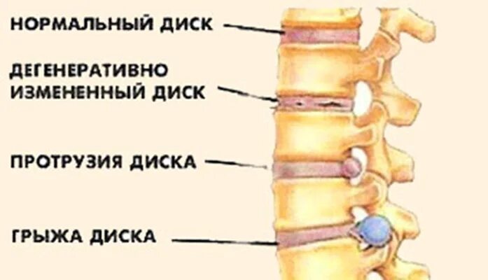 Протрузия это. Протрузия дисков позвоночника поясничного. протрузия поясничного отдела. грыжа позвоночника размеры. препараты от протрузии дисков.