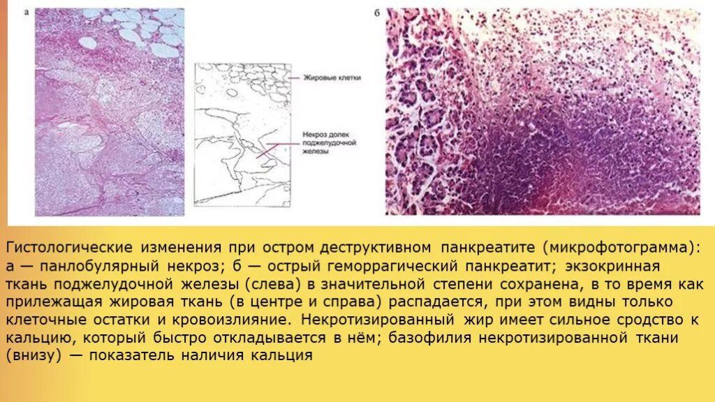 Аппендицит патанатомия. Острый панкреонекроз препарат патанатомия. Макропрепарат острый панкреатит _некроз поджелудочной железы. Хронический панкреатит патанатомия препарат. Острый геморрагический панкреатит гистология.