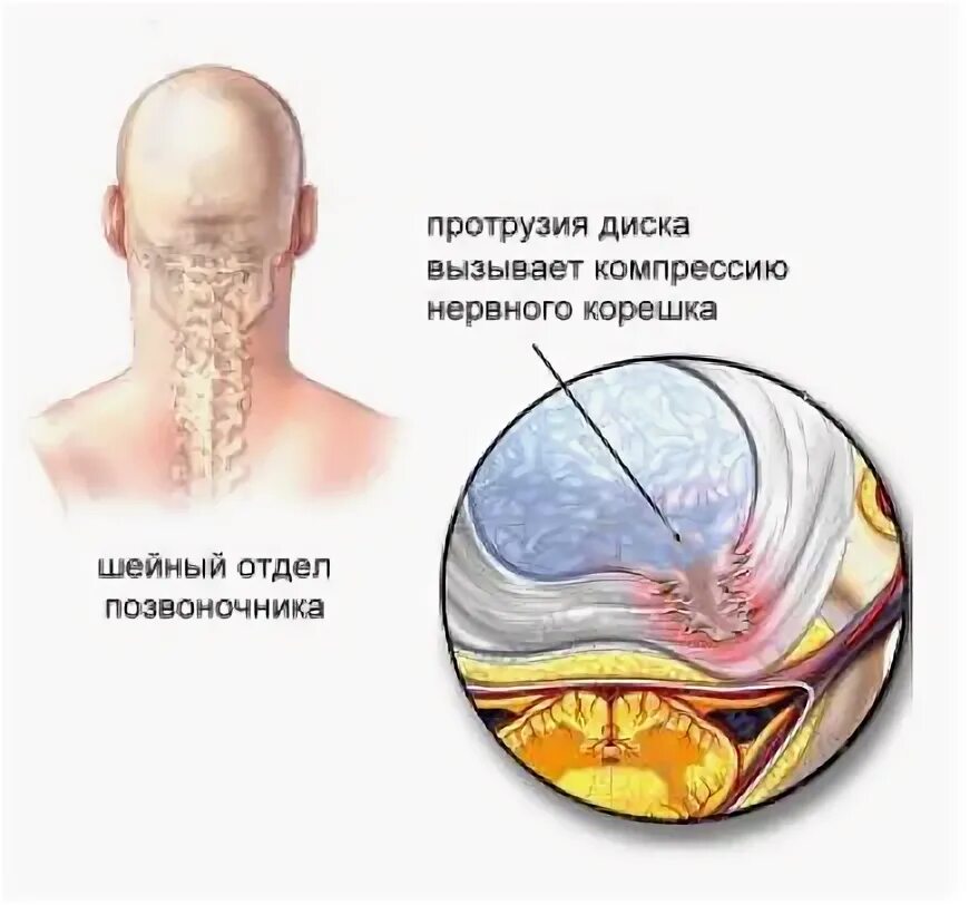 Протрузия шейного отдела позвоночника симптомы. Лечения протрузий шейного отдела лучшие специалисты в Барнауле.