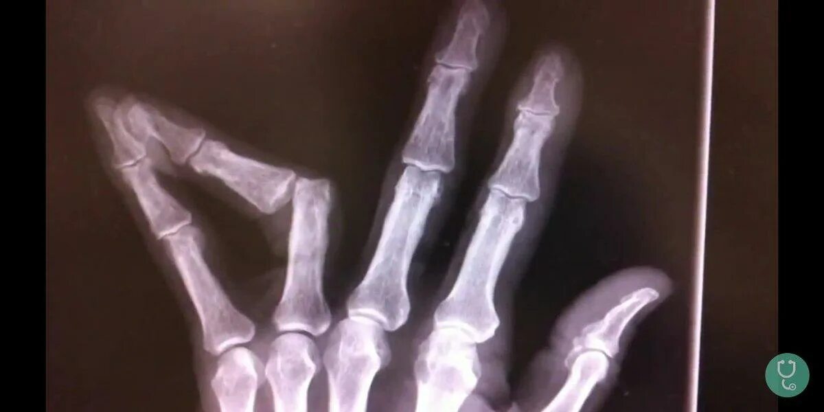 Трещина фаланги. Перелом фаланги мизинца рентгенограмма. Перелом фаланги пальца рентген. Субкапитальный перелом 5 пястной кости. Эпифизеолиз ногтевой фаланги.