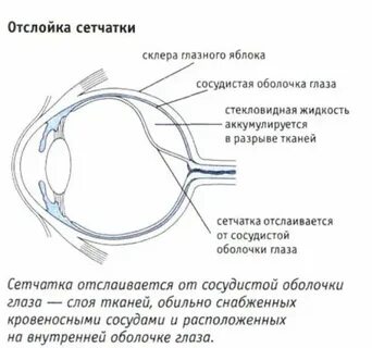 Восстановление сетчатки после операции