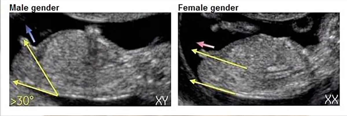 Определение пола 12 недель. Пол ребенка на УЗИ. Мальчик и девочка на УЗИ. УЗИ 14 недель пол ребенка.