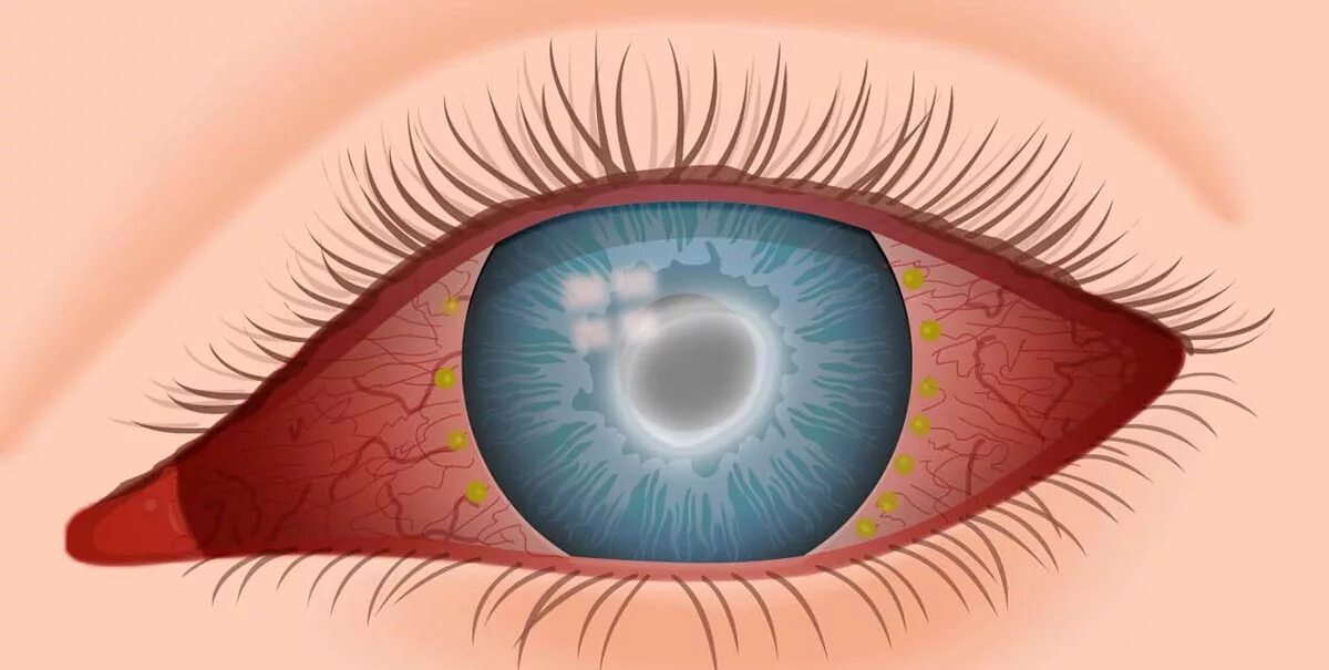 Глазной конъюнктивит лечение. Акантабельный кератии. Лимбальный кератоконъюнктивит.