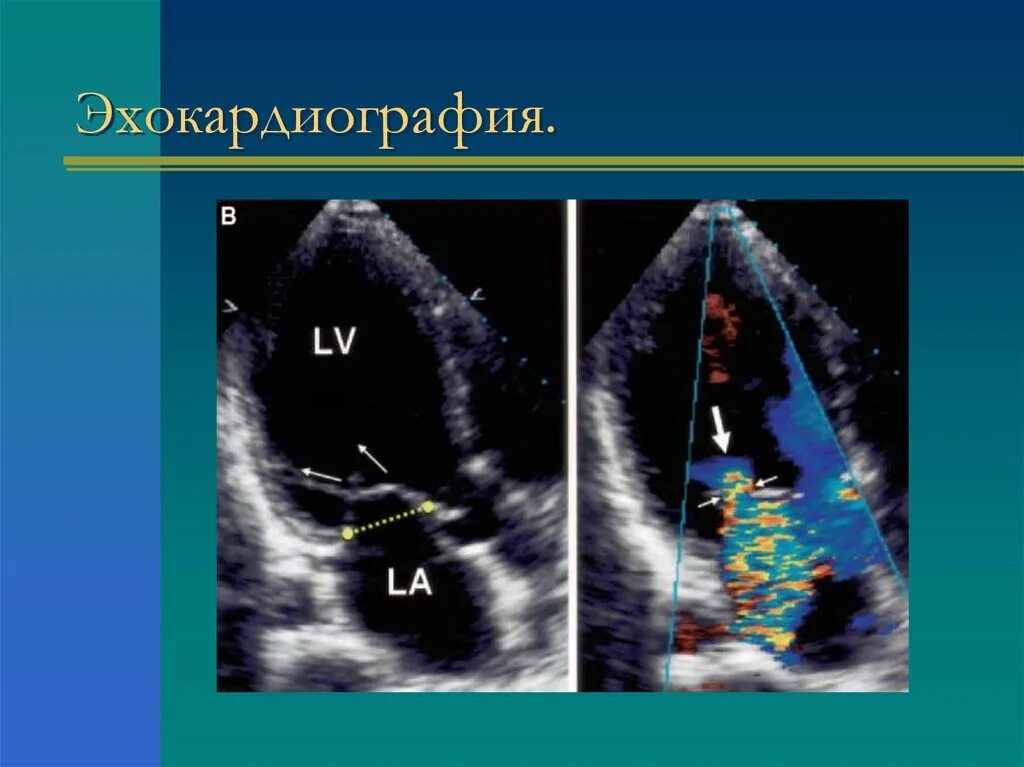 Эхо кардиография. Эхокардиография. Эхокардиография сердца. Эхокардиография с графическим изображением. Эхокардиография режимы.