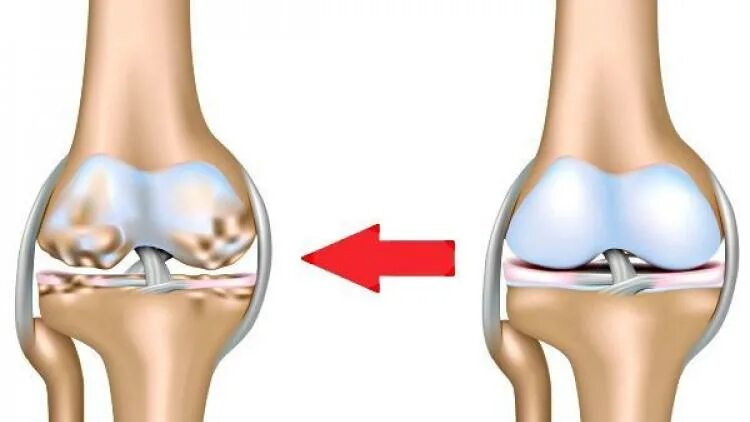 Артроз коленного сустава название. Остеоартрит коленного сустава. Разрушение хрящевой ткани коленного сустава.