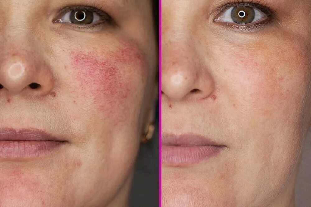 Лазерное удаление синяков. Vbeam perfecta лазер. Мезотерапия темных кругов под глазами. Камуфляж темных кругов под глазами татуаж. Мезотерапия глаз от темных кругов.