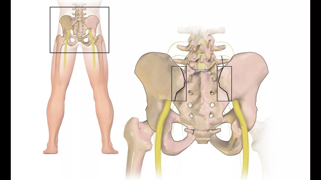 Боль в подвздошной кости. Крестцово подвздошное сочленение болезнь сакроилеит. Воспаление крестцово-подвздошного сустава. Мрт КПС (крестцово-подвздошных сочленений). КПС сустав крестцово-подвздошный.