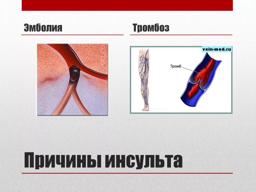 Причины тромбозов и эмболий. Причины артериальной эмболии. Тромбоз и тромбоэмболия