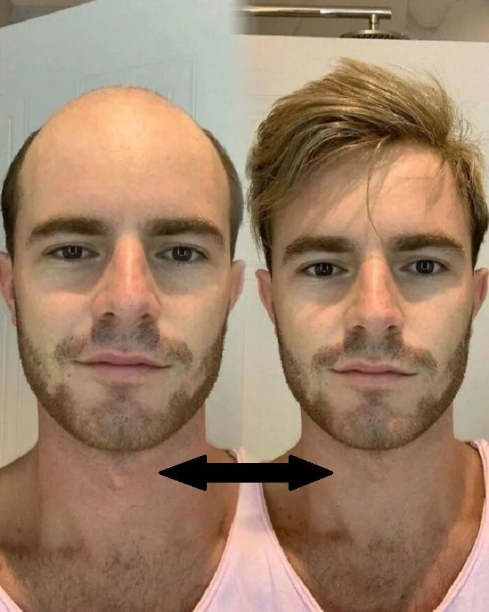Волосы до после мужчины. Замещение волос у мужчин. Система волос для мужчин. Филировка волос до и после у мужчин. Парик до и после до и после мужчина.