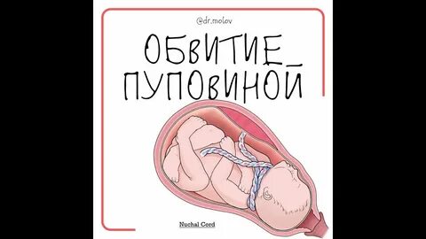Однократное обвитие на 32 неделе