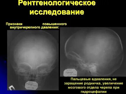 Признаки черепного