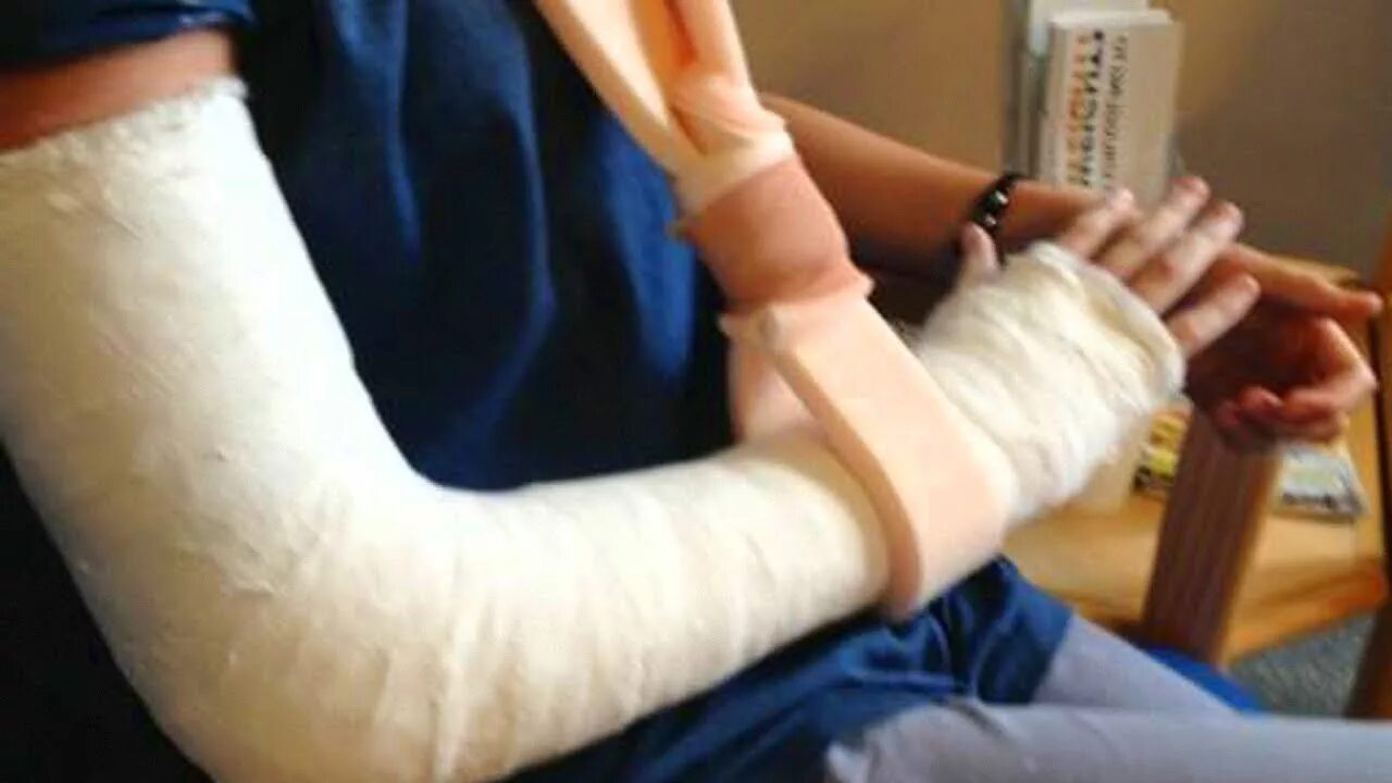 Хожу с гипсом на руке