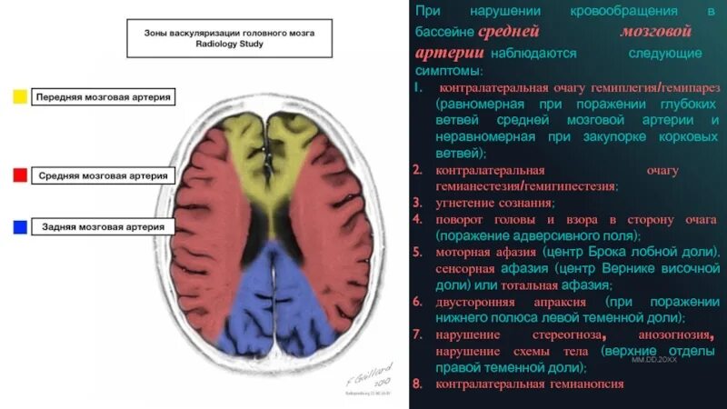 Левая средняя мозговая артерия инсульт. Клиника поражения левой средней мозговой артерии. Ишемический инсульт при поражении средней мозговой артерии. ОНМК В правой средней мозговой артерии клиника. Инсульт бассейн левой средней мозговой артерии кт.