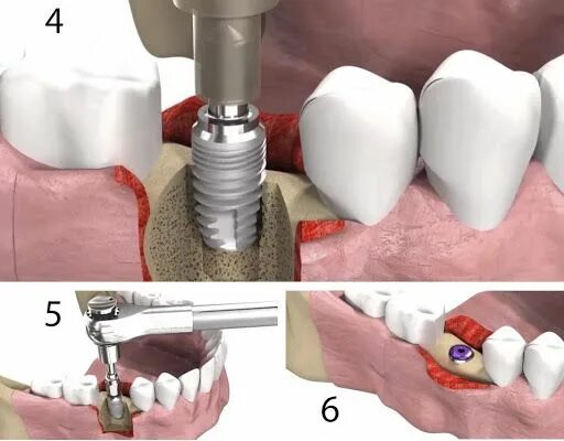 Зубы импланты поэтапно. Импланты Осстем винт заглушка. Этапы имплантации зубов абатмент. Этапы имплантации зуба абатмент. Имплантация зубов этапы установки.