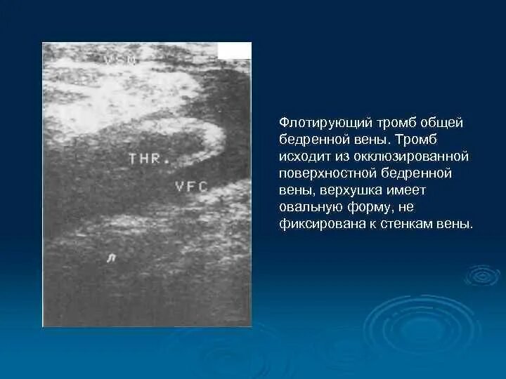 Флотирующий тромб. Острый флотирующий флеботромбоз. что такое флотирующий тромбофлебит. флотирующий тромб нижней конечности. флотирующий тромб поверхностной вены.