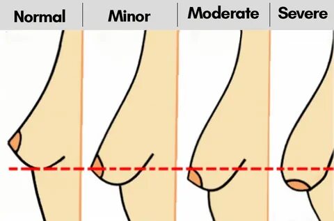 Know About Causes and How to Prevent Sagging Breas.