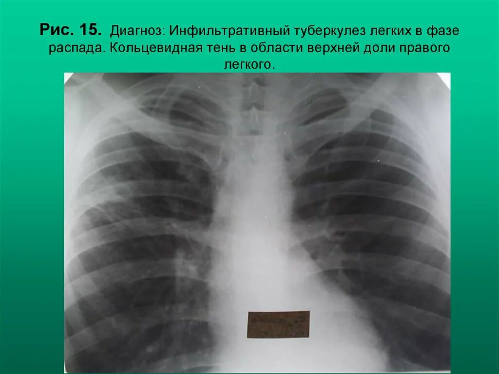 синдром кольцевой тени. кольцевидная тень туберкулез. синдром кольцевидной тени в легком. тень в правом легком. кольцевидная тень на флюорографии.