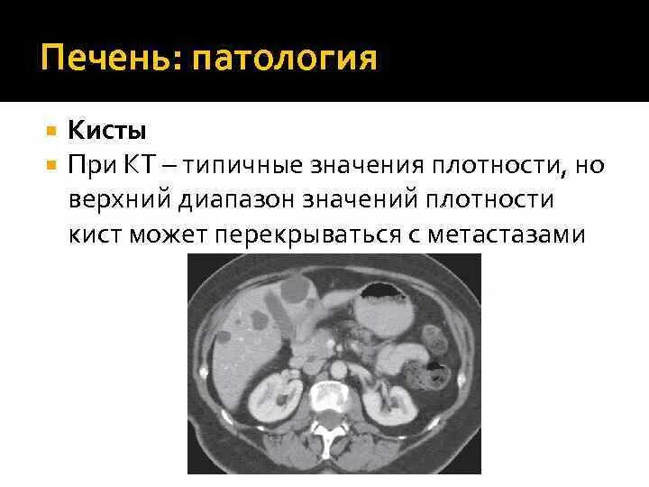 Что значат кисты на печени. Кистозные метастазы в печени на кт. Увеличение плотности печени на кт.