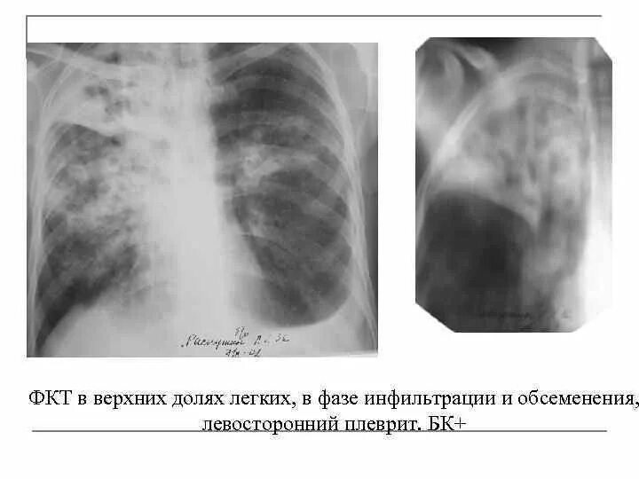 Очаговый туберкулез легких на кт. Туберкулез в фазе инфильтрации и распада. Лобулярный инфильтративный туберкулез рентген. Туберкулез в фазе инфильтрации и распада. Милиарный туберкулез фаза инфильтрации.