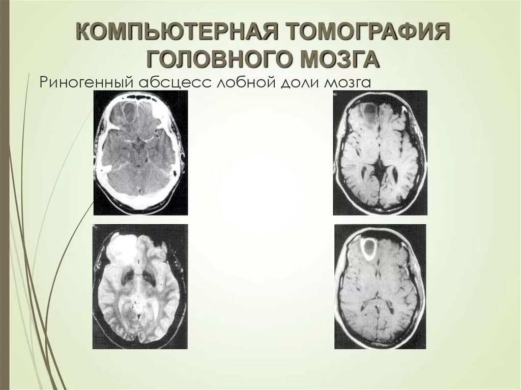 Эпидуральный абсцесс головного мозга мрт. Менингит абсцесс мозга. Отогенный менингит. Лейкомаляция кт. Риногенный абсцесс головного мозга.