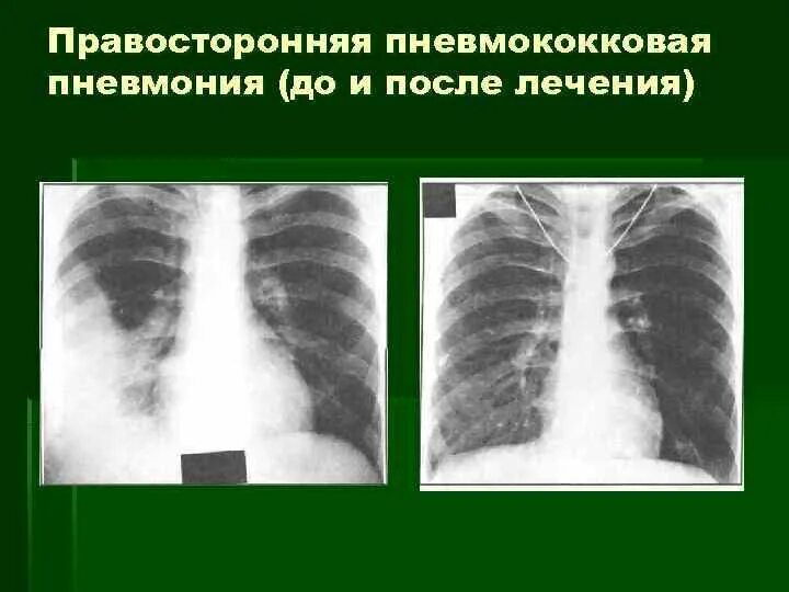 Пневмония снимок. Пневмония на рентгене. Пневмококковая пневмония. Рентгеновский снимок пневмонии.