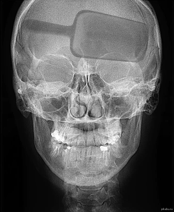 Рентгенография черепа в носолобной проекции. Носолобная проекция рентген. Рентген черепа перелом лобной кости на рентгене.