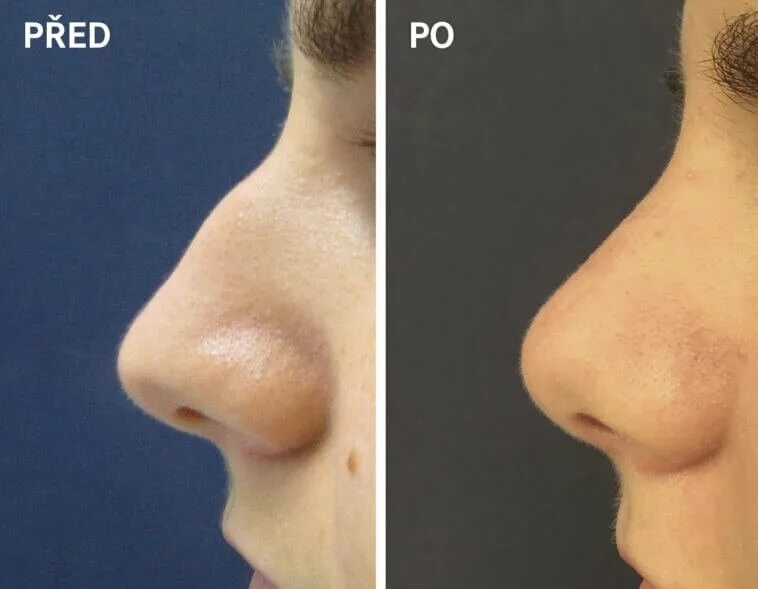 Маленькие изменения. Клювовидный нос ринопластика. Операции носа пластические операции. Клювовидный нос после пластики. Каплевидный нос.