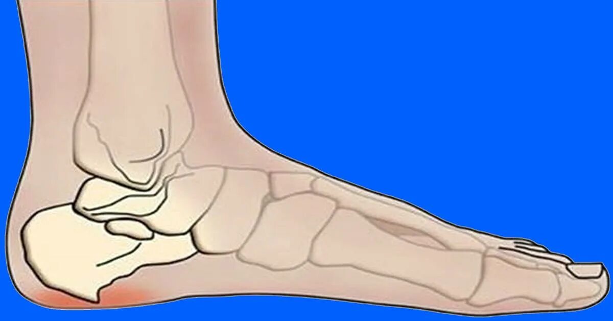 Пяточный шип. Костный шип — пяточная шпора. Пяточная кость шпора рентген. Пяточная шпора н аренгене. Пяточная шпора рентген.