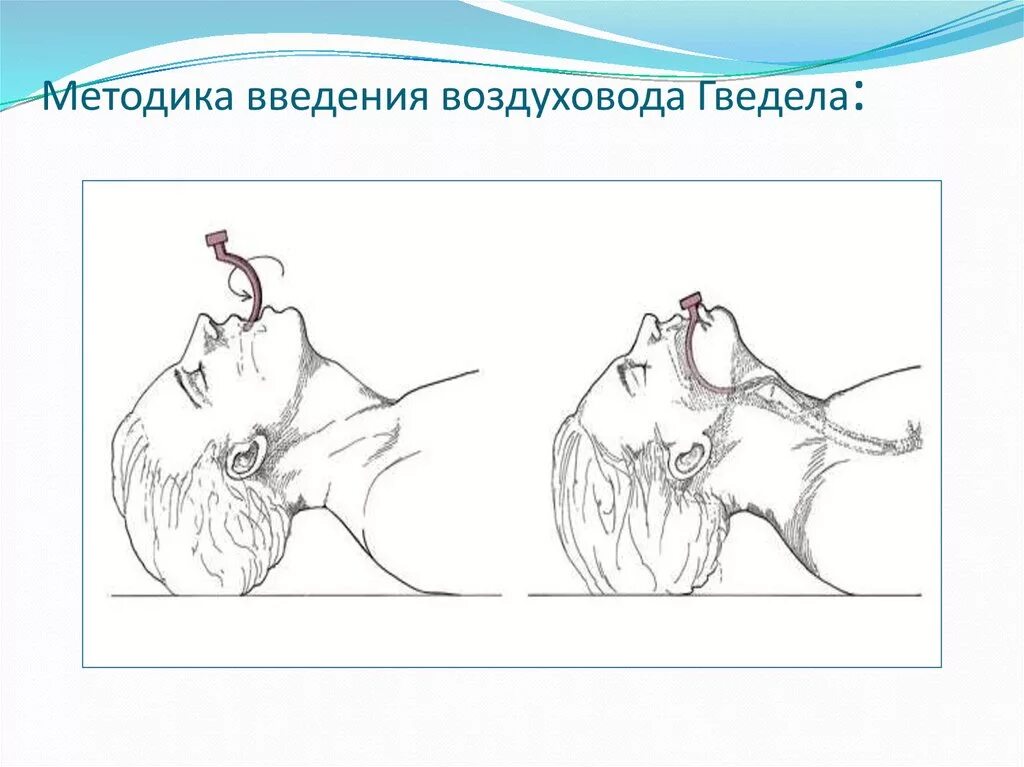 Воздуховод алгоритм. Введение воздуховода алгоритм. введение ротоглоточного воздуховода алгоритм. введение воздуховода гведела. введение орофарингеального воздуховода.