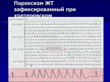 Пароксизм