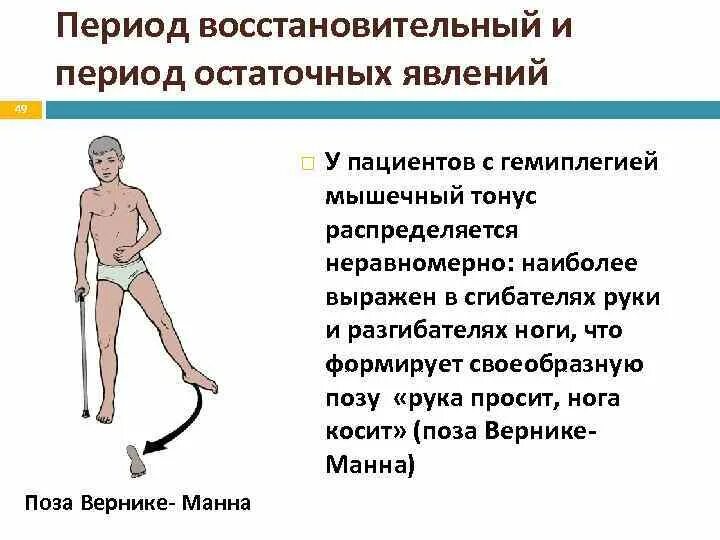 Гемиплегия Вернике — Манна. Спастический гемипарез с позой Вернике-Манна.. Гемипаретическая походка и Вернике Манна. Поза Вернике Манна. Код гемипареза