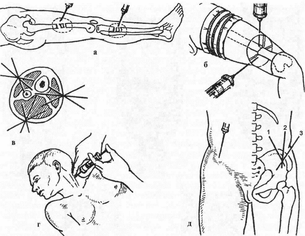 Обезболивающая блокада. Новокаиновая блокада брыжейки. Футлярная новокаиновая блокада по Вишневскому техника. Внутрикожная новокаиновая блокада алгоритм. Проведение новокаиновых блокад.