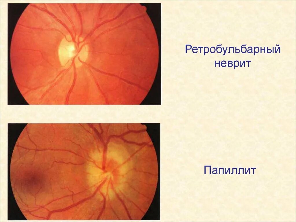 Нисходящая атрофия. Неврит зрительного нерва и ретробульбарный неврит. Папиллит (оптический неврит). Неврит зрительного нерва глазное дно. Ретробульбарный неврит (папиллит).