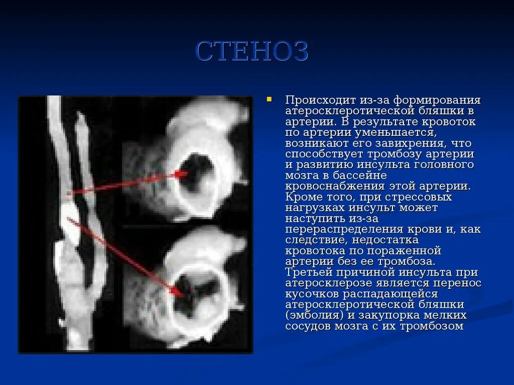 Стеноз проксимального отдела. Эксцентрический стеноз. Стеноз прямой