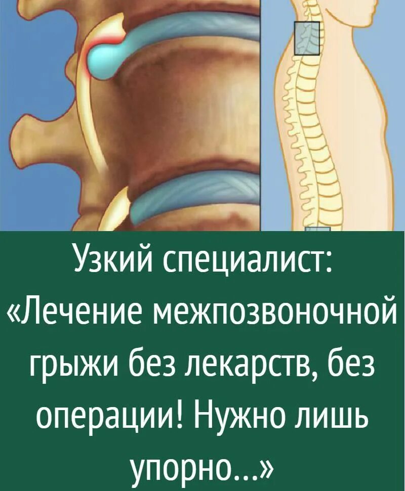 Как лечить грыжа диска без операции. Грыжа позвоночника. лекарство для грыжи позвоночника. как вылечить межпозвоночную грыжу. загрызание позвоночной грыжи.