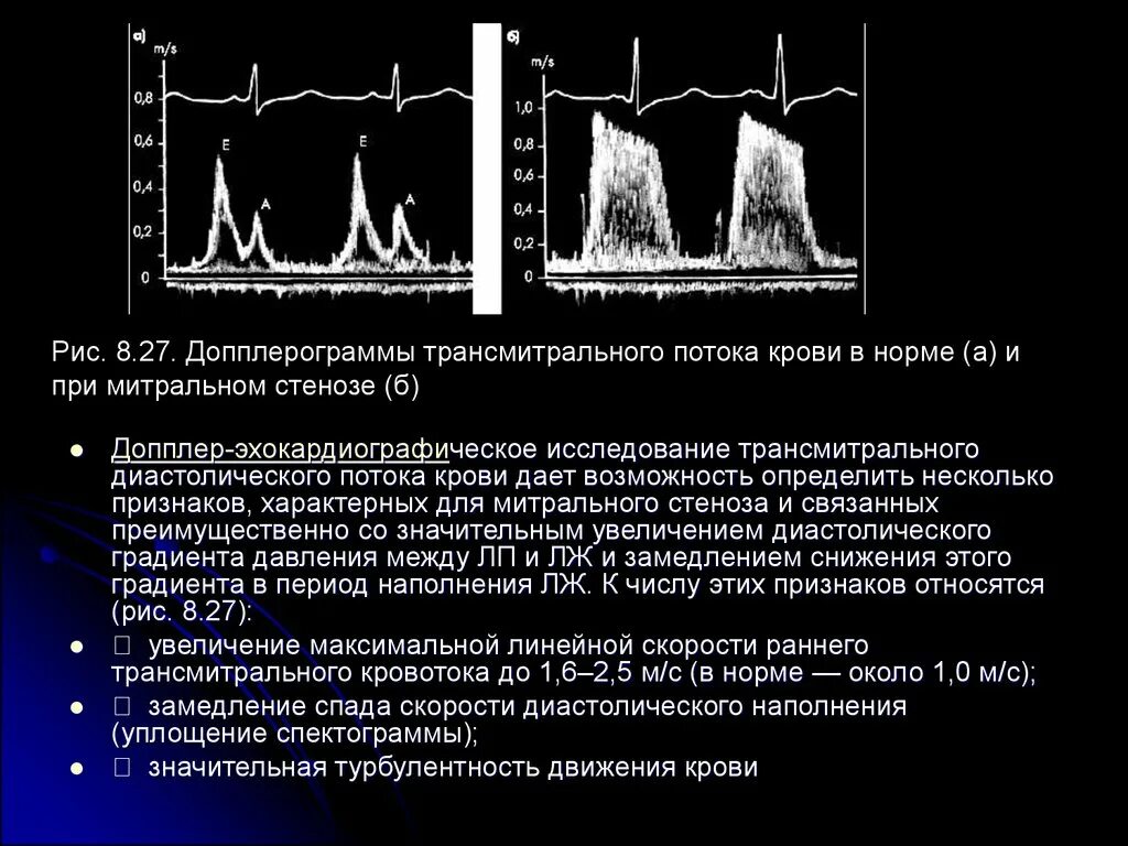 Впс трехстворчатый аортальный клапан. Трансмитральный поток норма. Митральный клапан норма на эхокг. Градиент на митральном клапане норма. Аортальная недостаточность допплер эхокг.