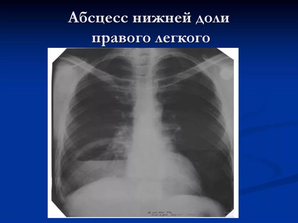 Доли правого лёгкого. Пневмония в нижней доле правого легкого