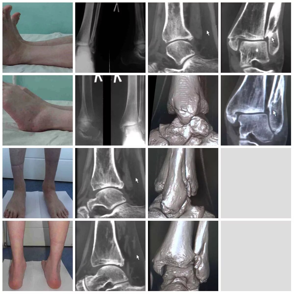 неправильно сросшийся перелом мкб. ложный сустав малоберцовой кости. неправильно сросшийся перелом мкб. неправильно сросшийся перелом мкб. закрытый перелом наружной лодыжки мкб.