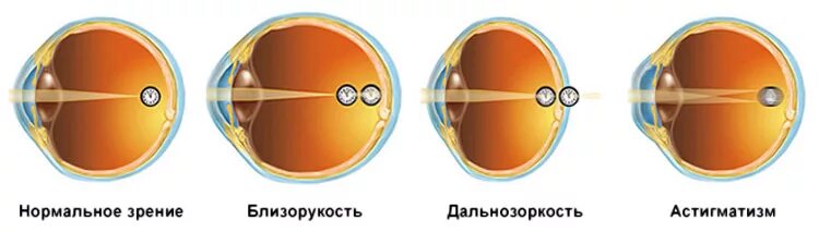 Миопия астигматизм глаз. Дефекты зрения близорукость и дальнозоркость. Нарушения рефракции близорукость дальнозоркость астигматизм. Нарушения рефракции глаза близорукость дальнозоркость. Аномалии рефракции: дальнозоркость, близорукость, астигматизм..