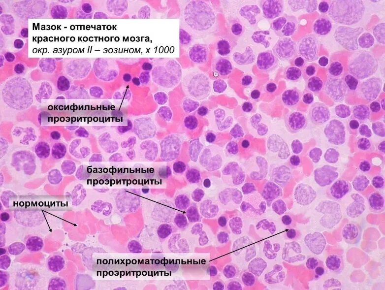 Печени и костного мозга. Красный костный мозг гистология препарат. Красный костный мозг гематоксилин эозин. Костный мозг гистология препарат. Мазок красного костного мозга Азур 2 эозин.