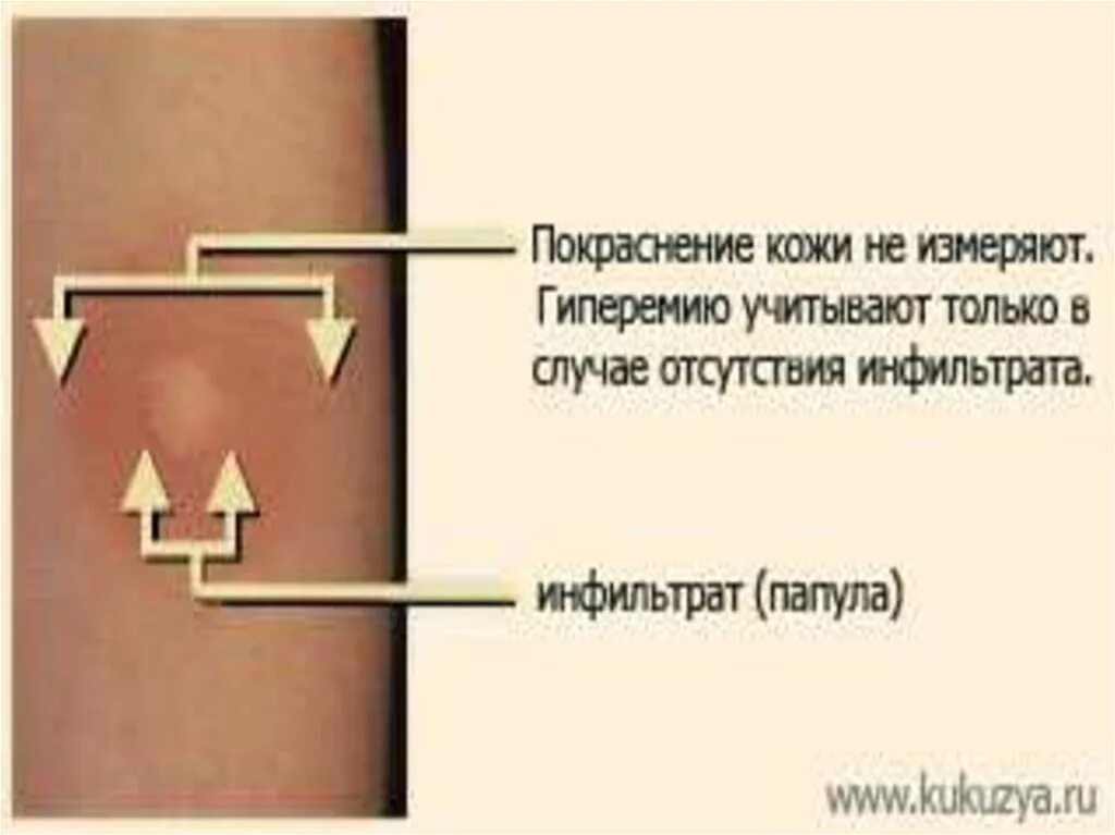 Можно пить после манты. Нормальная папула манту. Туберкулин реакция манту положительная. Папула и гиперемия манту.