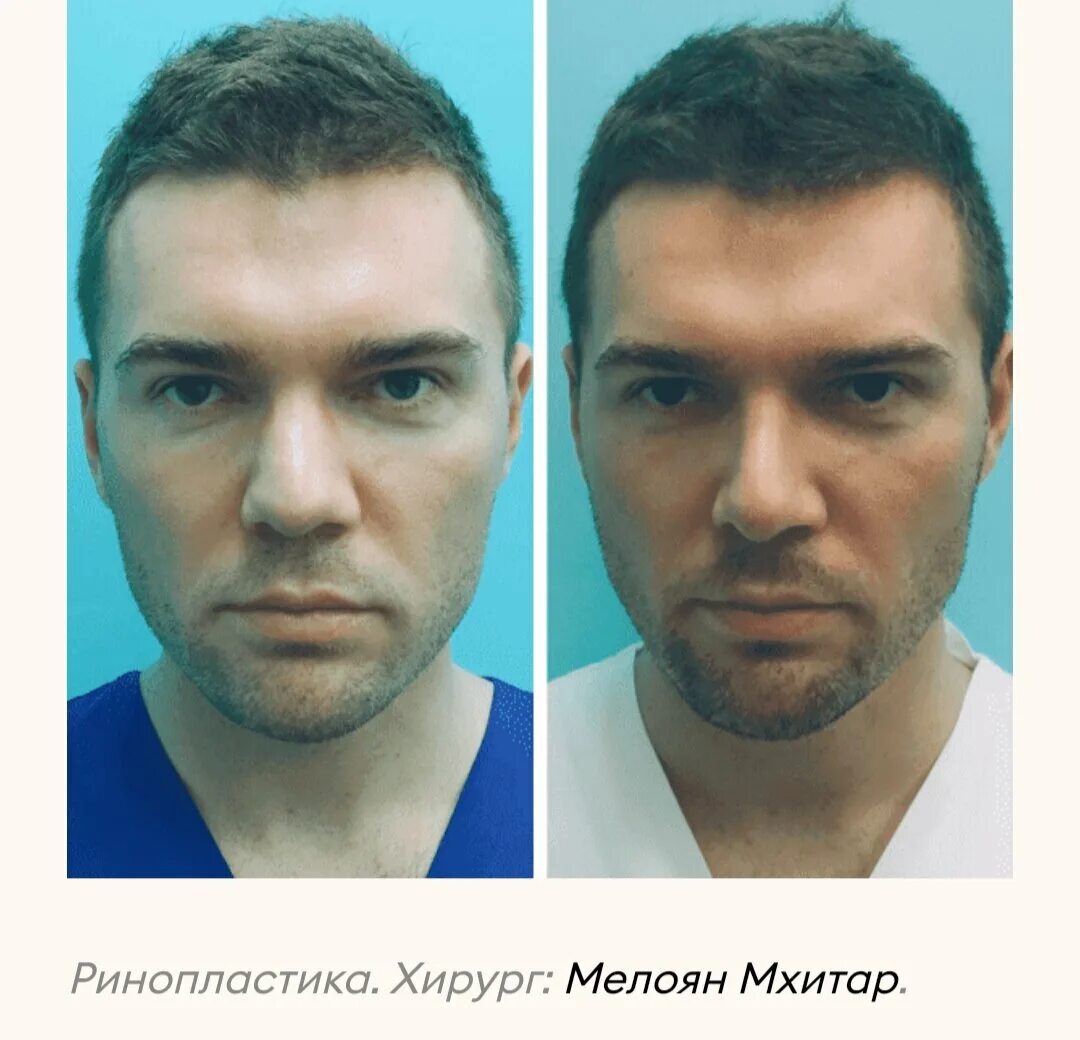Мужчины после операции. Мелоян Мхитар Мисакович. Искорнев пластический хирург до и после. Ринопластика до и после мужчины.
