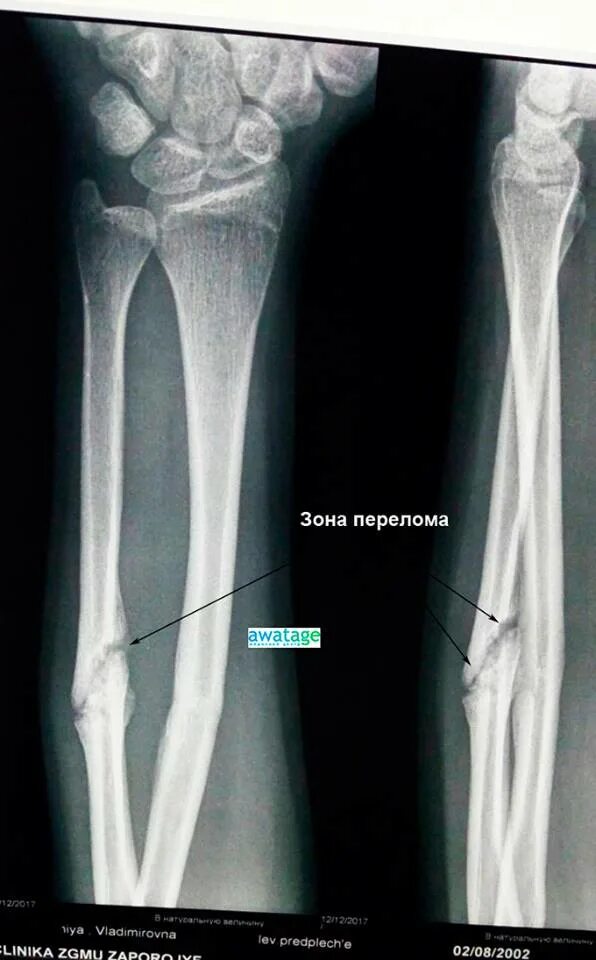 Несросшийся перелом рентген. Сросшийся перелом кости. Сросшийся перелом на рентгене.